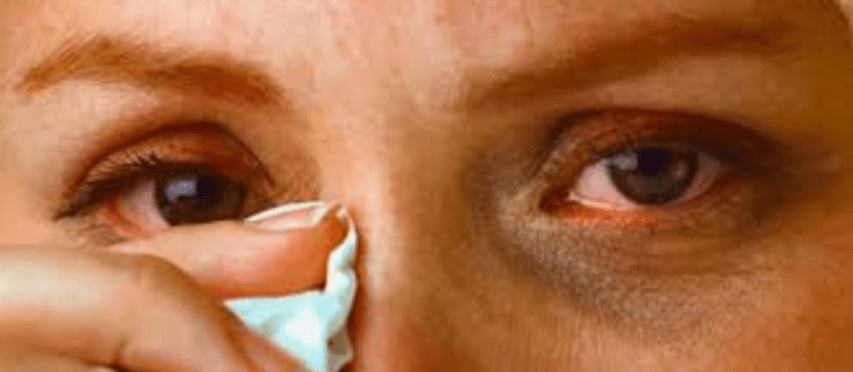 Herpès oculaire : Symptômes, Traitements & Complications