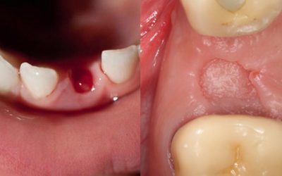 Comment se passe la cicatrisation après extraction dentaire ?