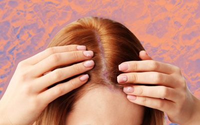 Psoriasis des cheveux : que faire ?