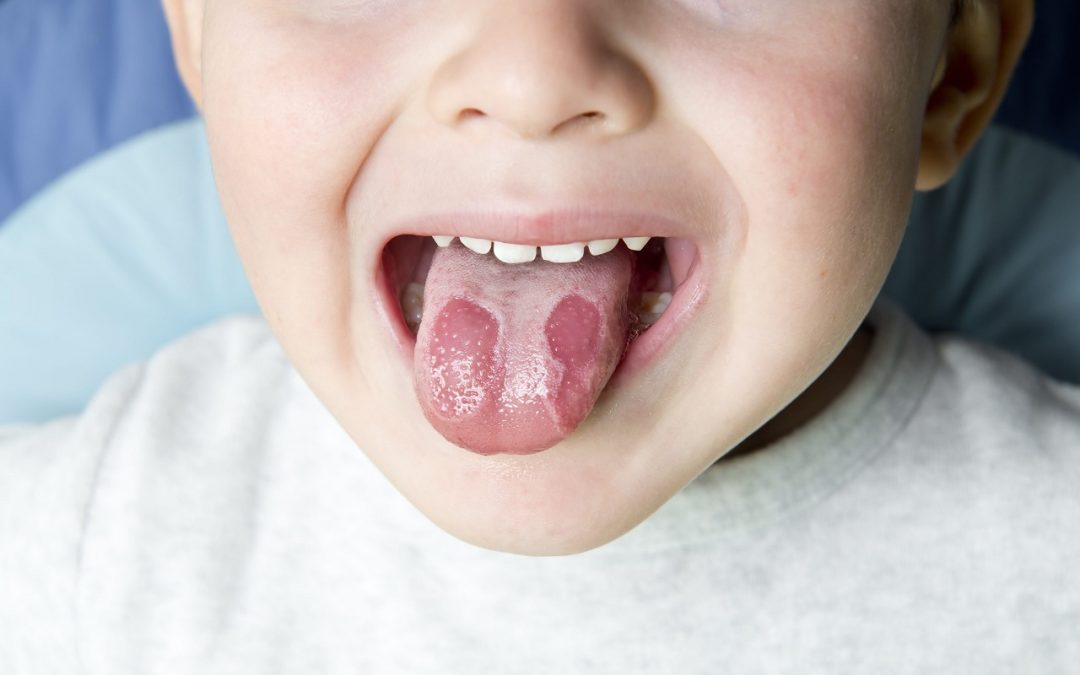 Qu’est-ce que le psoriasis de la langue ?      