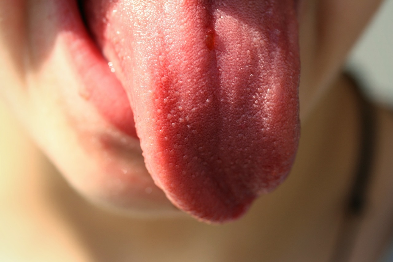 Le psoriasis de la langue