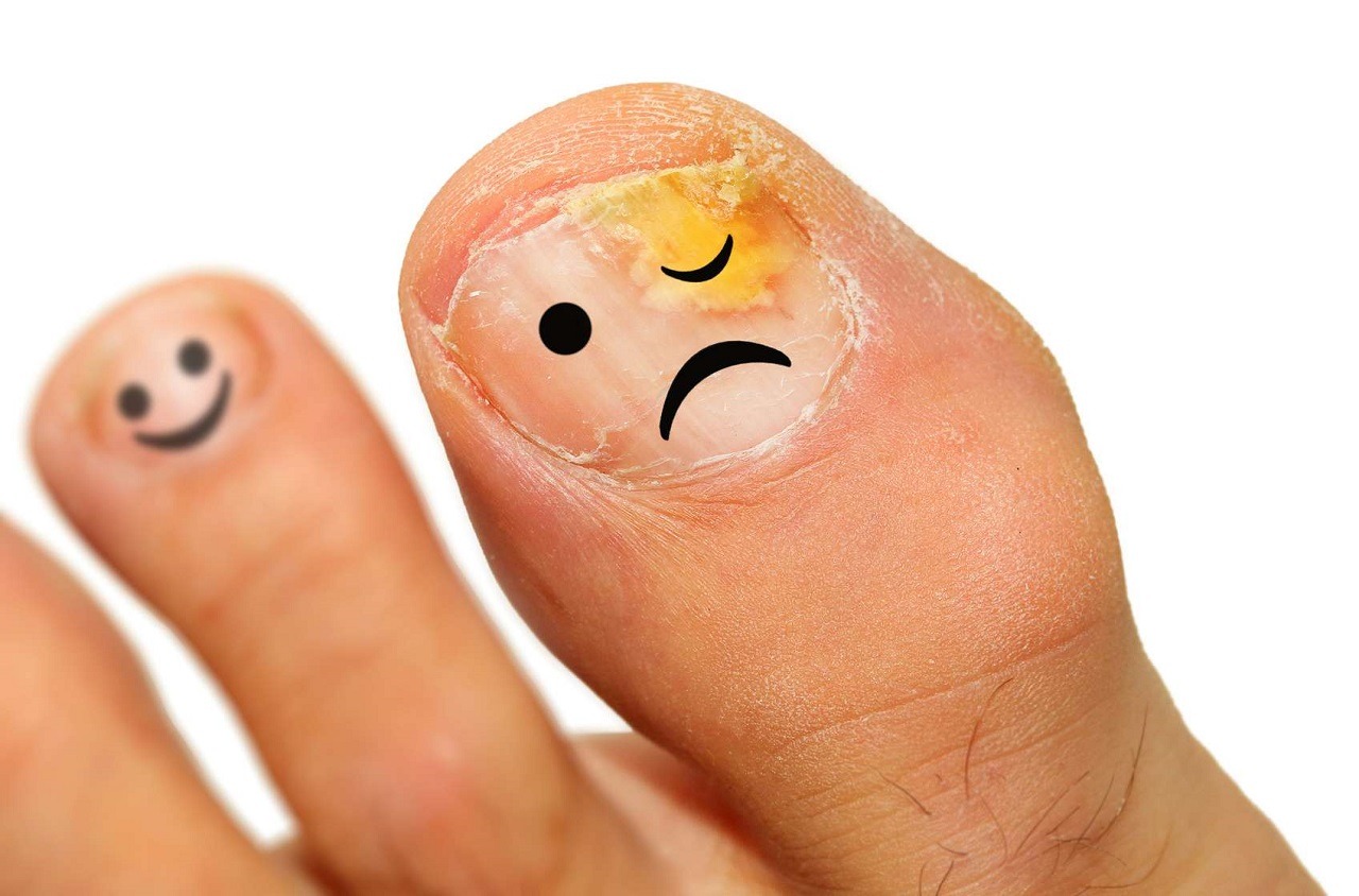 Le psoriasis des ongles peut parfois être évité