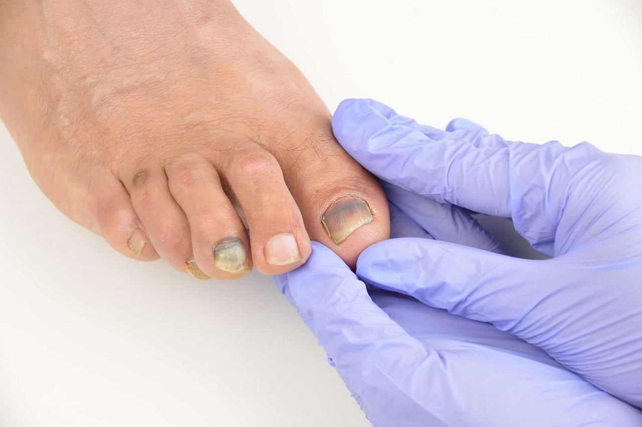 Le psoriasis des ongles est un trouble inflammatoire auto-immune
