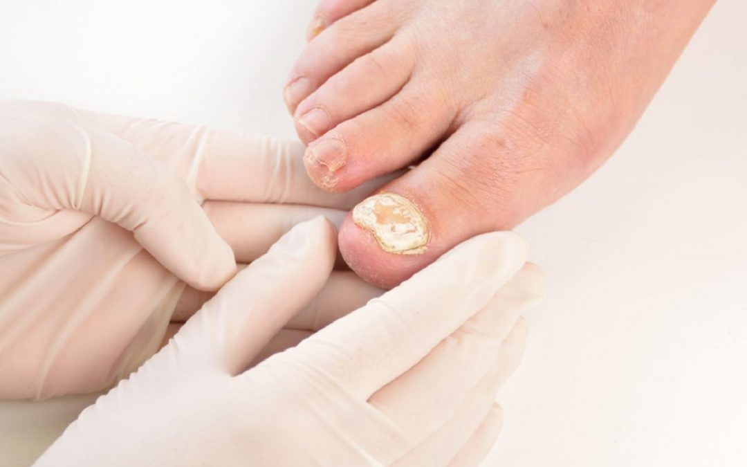 Psoriasis des ongles : comment le reconnaître et le traiter ?