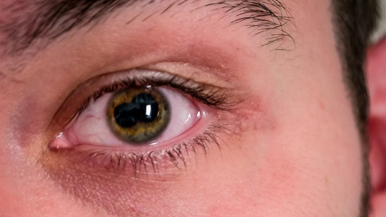 Psoriasis-yeux