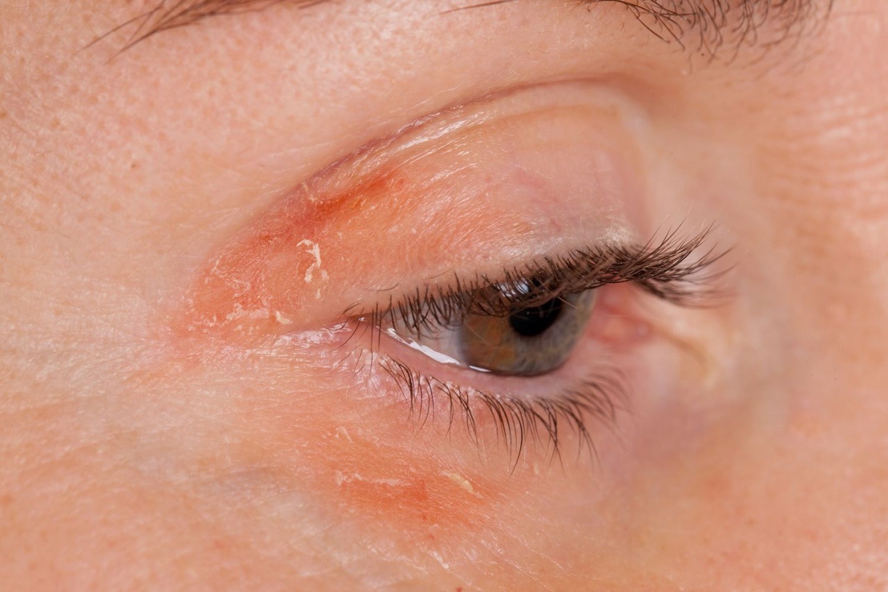 Psoriasis yeux